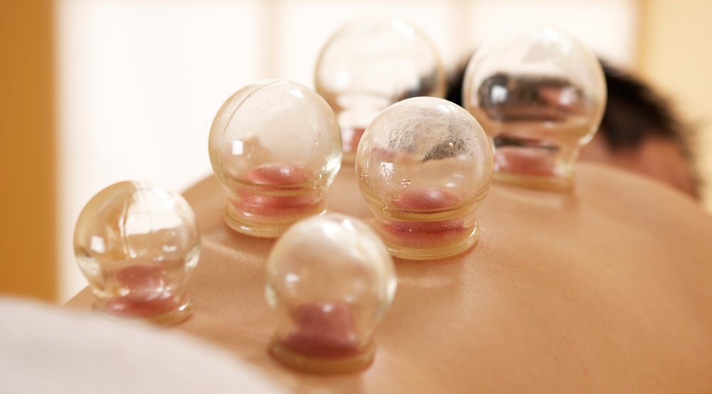 6 Things to Know About Cupping Therapy Muscle Fitness