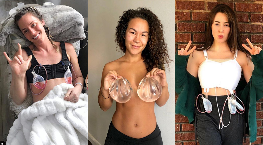 My Breast Augmentation Experience