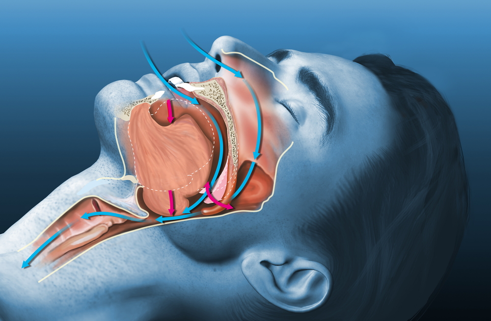 which snoring devices actually work